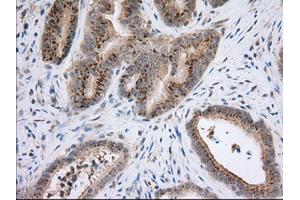 Immunohistochemical staining of paraffin-embedded Adenocarcinoma of Human colon tissue using anti-NXNL2 mouse monoclonal antibody. (NXNL2 anticorps)