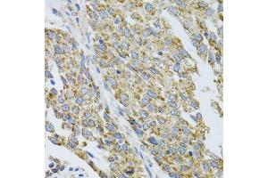 Immunohistochemistry of paraffin-embedded human lung cancer using CYP1A1 antibody.