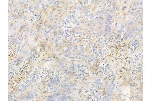 ABIN6257943 and ABIN6274678 at 1/100 staining human lung squamous cell carcinoma by IHC-P.