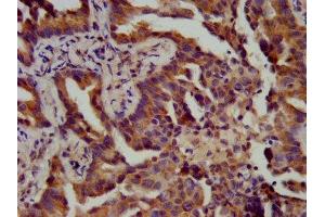 IHC image of ABIN7144824 diluted at 1:400 and staining in paraffin-embedded human lung cancer performed on a Leica BondTM system.