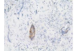 ABIN6256686 and ABIN6267254 at 1/100 staining human pancreatic carcinoma by IHC-P. (ABL1 anticorps  (pTyr245))