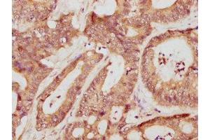 IHC image of ABIN7177875 diluted at 1:709 and staining in paraffin-embedded human colon cancer performed on a Leica BondTM system.