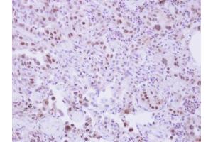 IHC-P Image Immunohistochemical analysis of paraffin-embedded human lung adenocarcinoma, using SLU7, antibody at 1:250 dilution. (SLU7 anticorps  (C-Term))
