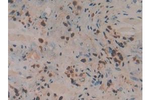 Detection of CORO1A in Human Prostate cancer Tissue using Polyclonal Antibody to Coronin 1A (CORO1A)