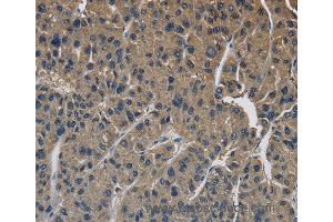 Immunohistochemistry of Human liver cancer using SIGMAR1 Polyclonal Antibody at dilution of 1:50