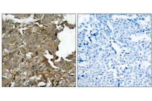 Immunohistochemical analysis of paraffin-embedded human breast carcinoma tissue using cofilin (Ab- 1022) antibody (E021164). (Cofilin anticorps)