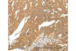 Immunohistochemistry of Human ovarian cancer using SKP1 Polyclonal Antibody at dilution of 1:30 (SKP1 anticorps)