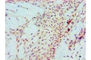 Immunohistochemical of paraffin-embedded Human breast cancer tissue using ABIN7172317 at dilution of 1:200.