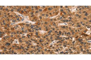 Immunohistochemistry of paraffin-embedded Human liver cancer tissue using CD159a/c Polyclonal Antibody at dilution 1:30 (CD159a/c anticorps)