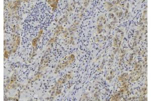 ABIN6273508 at 1/100 staining Human lung cancer tissue by IHC-P. (GZMK anticorps  (Internal Region))