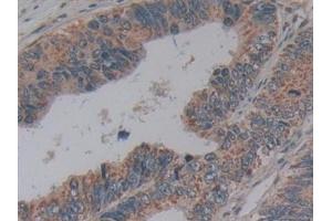 Detection of MFAP2 in Human Colorectal cancer Tissue using Polyclonal Antibody to Microfibrillar Associated Protein 2 (MFAP2)
