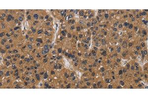 Immunohistochemistry of paraffin-embedded Human liver cancer tissue using E2F4 Polyclonal Antibody at dilution 1:40 (E2F4 anticorps)