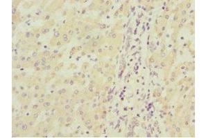 Immunohistochemistry of paraffin-embedded human liver cancer using ABIN7160192 at dilution of 1:100 (MGLL anticorps  (AA 1-303))