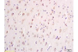 Formalin-fixed and paraffin embedded human glioma carcinoma labeled with Anti DTNB Polyclonal Antibody, Unconjugated (ABIN700630) at 1:200 followed by conjugation to the secondary antibody and DAB staining (Dystrobrevin beta anticorps  (AA 261-370))