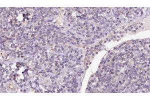 ABIN6273174 at 1/100 staining Human lymph cancer tissue by IHC-P. (Syntaxin 16 anticorps  (N-Term))