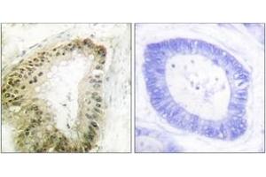 Immunohistochemistry analysis of paraffin-embedded human colon carcinoma, using LKB1 (Phospho-Ser428) Antibody.