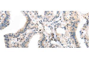 Immunohistochemistry of paraffin-embedded Human thyroid cancer using TBXA2R Polyclonal Antibody at dilution of 1/40 (TBXA2R anticorps)