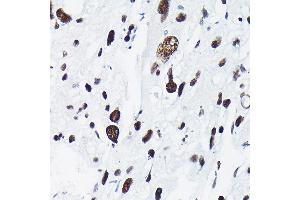 Immunohistochemistry of paraffin-embedded human liver cancer using Phospho-c-Jun-T91 Rabbit pAb (ABIN7268058) at dilution of 1:50 (40x lens). (C-JUN anticorps  (pThr91))