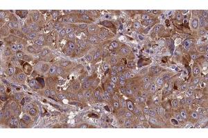 ABIN6273850 at 1/100 staining Human liver cancer tissue by IHC-P. (G Protein-Coupled Receptor 1 anticorps  (C-Term))