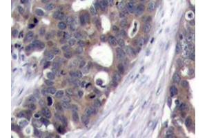 Immunohistochemistry analyzes of p70 S6K antibody in paraffin-embedded human breast carcinoma tissue. (RPS6KB1 anticorps)
