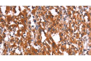 Immunohistochemistry of paraffin-embedded Human thyroid cancer using HMGCS2 Polyclonal Antibody at dilution of 1:40 (HMGCS2 anticorps)