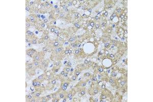 Immunohistochemistry of paraffin-embedded human liver injury using AARS2 antibody at dilution of 1:100 (x40 lens). (AARS2 anticorps)