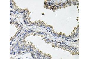 Immunohistochemistry of paraffin-embedded Human prostate using ACO1 Polyclonal Antibody at dilution of 1:100 (40x lens). (Aconitase 1 anticorps)