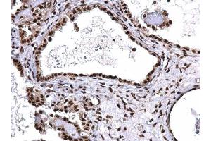 IHC-P Image SNRPD2 antibody detects SNRPD2 protein at nucleus on human ovarian carcinoma by immunohistochemical analysis.