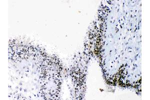 HMGB1 was detected in paraffin-embedded sections of human mammary cancer  tissues using rabbit anti- HMGB1 Antigen Affinity purified polyclonal antibody (Catalog # ) at 1 µg/mL. (HMGB1 anticorps  (C-Term))