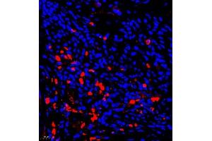 Immunofluorescence of paraffin embedded human liver cancer using AHSG (ABIN7073021) at dilution of 1:650 (400x lens)