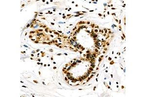 Immunohistochemistry of paraffin embedded human breast cancer using Transketolase (ABIN7075978) at dilution of 1: 2200 (400x lens)