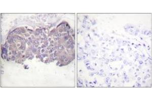 Immunohistochemistry analysis of paraffin-embedded human breast carcinoma, using HSL (Phospho-Ser552) Antibody. (LIPE anticorps  (pSer552))