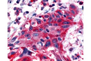 Anti-NTSR2 / NTR2 antibody IHC of human Skin, Melanoma.