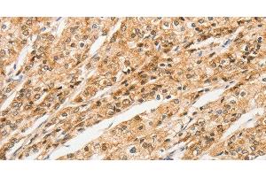 Immunohistochemistry of paraffin-embedded Human prostate cancer tissue using STAM Polyclonal Antibody at dilution 1:40 (STAM anticorps)