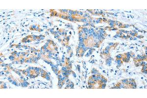 Immunohistochemistry of paraffin-embedded Human colon cancer using IMMT Polyclonal Antibody at dilution of 1:70 (IMMT anticorps)