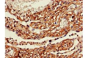 IHC image of ABIN7158511 diluted at 1:600 and staining in paraffin-embedded human lung cancer performed on a Leica BondTM system.