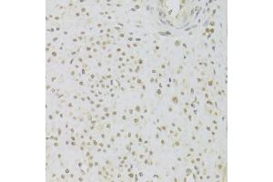 Immunohistochemistry of paraffin-embedded human leiomyoma of uterus using PRPF3 Antibody (ABIN5973192) at dilution of 1/100 (40x lens). (PRPF3 anticorps)