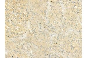 ABIN6259863 and ABIN6279104 at 1/100 staining human hepatocellular carcinoma by IHC-P.