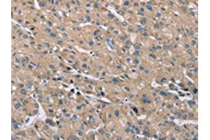 The image on the left is immunohistochemistry of paraffin-embedded Human liver cancer tissue using ABIN7192262(SAMD9L Antibody) at dilution 1/30, on the right is treated with synthetic peptide. (SAMD9L anticorps)