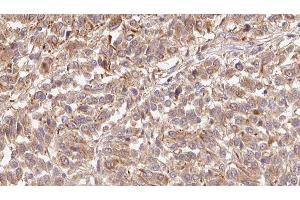 ABIN6279428 at 1/100 staining Human Melanoma tissue by IHC-P. (Fibulin 1 anticorps  (Internal Region))