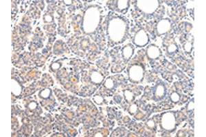 The image on the left is immunohistochemistry of paraffin-embedded Human thyroid cancer tissue using ABIN7131592(VPS54 Antibody) at dilution 1/20, on the right is treated with fusion protein. (VPS54 anticorps)