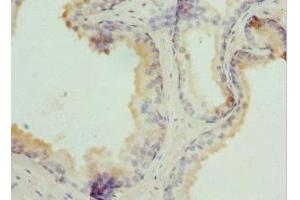 Immunohistochemistry of paraffin-embedded human prostate cancer using ABIN7173912 at dilution of 1:100
