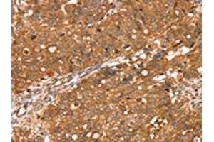 The image on the left is immunohistochemistry of paraffin-embedded Human breast cancer tissue using ABIN7130892(RNASET2 Antibody) at dilution 1/30, on the right is treated with fusion protein. (RNASET2 anticorps)