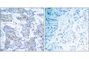 Immunohistochemistry analysis of paraffin-embedded human breast carcinoma tissue, using HER2 (Ab-1248) Antibody. (ErbB2/Her2 anticorps  (AA 1206-1255))
