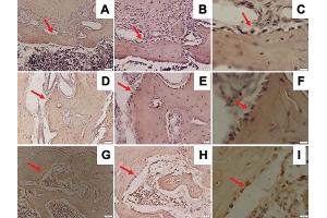 Representative images of immunohistochemical RANKL expression in the mandible of Wistar rats in diabetic group with ×200 magnification (A), ×400 magnification (B), ×1,000 magnification (C); osteoporotic group with ×200 magnification (D), ×400 magnification (E), ×1,000 magnification (F); and control group with ×200 magnification (G), ×400 magnification (H), ×1,000 magnification (I); and RANKL-positive cells were observed (red arrow). (RANKL anticorps  (AA 74-308))
