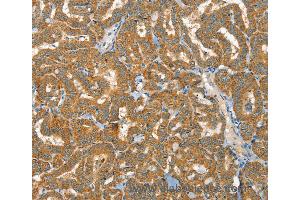 Immunohistochemistry of Human liver cancer using RAB25 Polyclonal Antibody at dilution of 1:40 (RAB25 anticorps)
