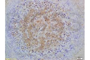 Formalin-fixed and paraffin embedded mouse lymphoma labeled with Anti-Smad3 Polyclonal Antibody, Unconjugated (ABIN747023) at 1:200 followed by conjugation to the secondary antibody and DAB staining (Smad2/3 anticorps  (AA 30-80))