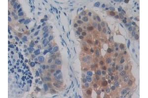 Detection of DCLK1 in Human Lung cancer Tissue using Polyclonal Antibody to Doublecortin Like Kinase 1 (DCLK1)