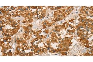 Immunohistochemistry of paraffin-embedded Human thyroid cancer tissue using RBBP8 Polyclonal Antibody at dilution 1:65